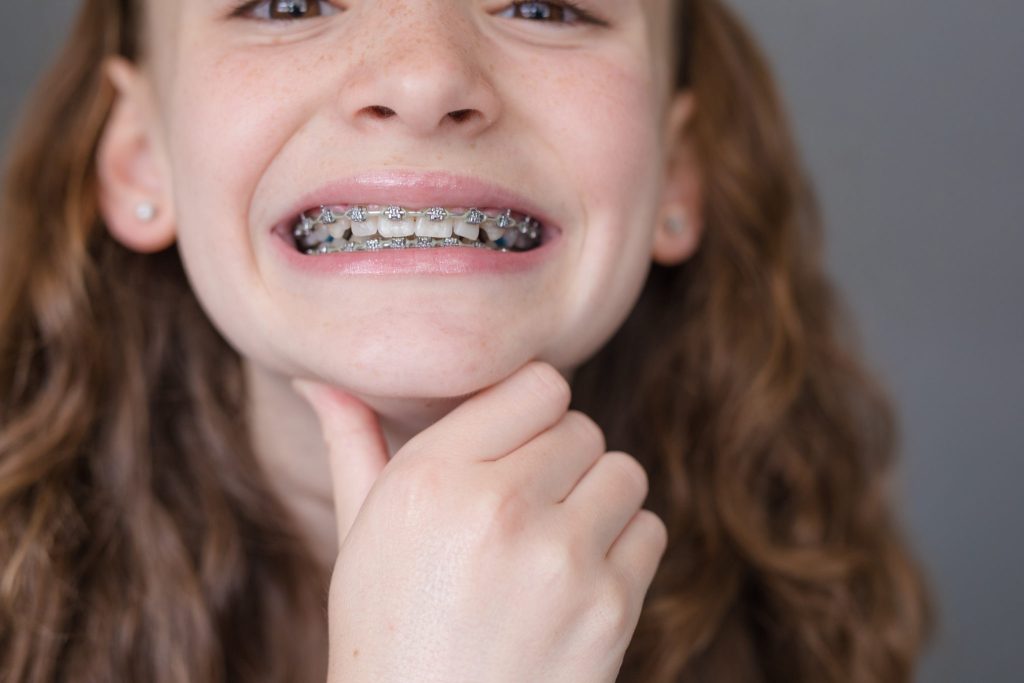 Achieving a Perfect Smile with Herbst Appliance Braces