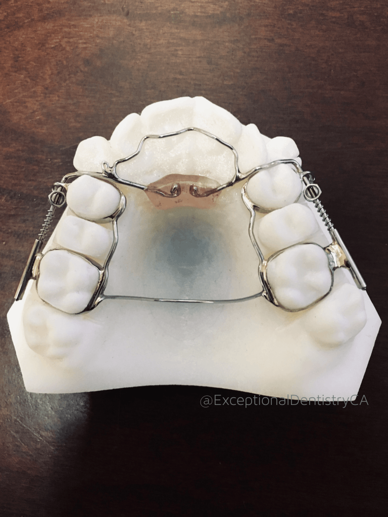 Anterior Growth Guidance Appliance: A Revolutionary Orthodontic Solution