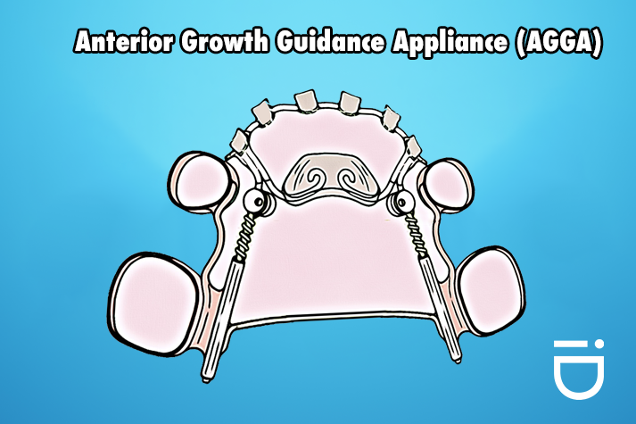 Anterior Growth Guidance Appliance: A Revolutionary Orthodontic Solution