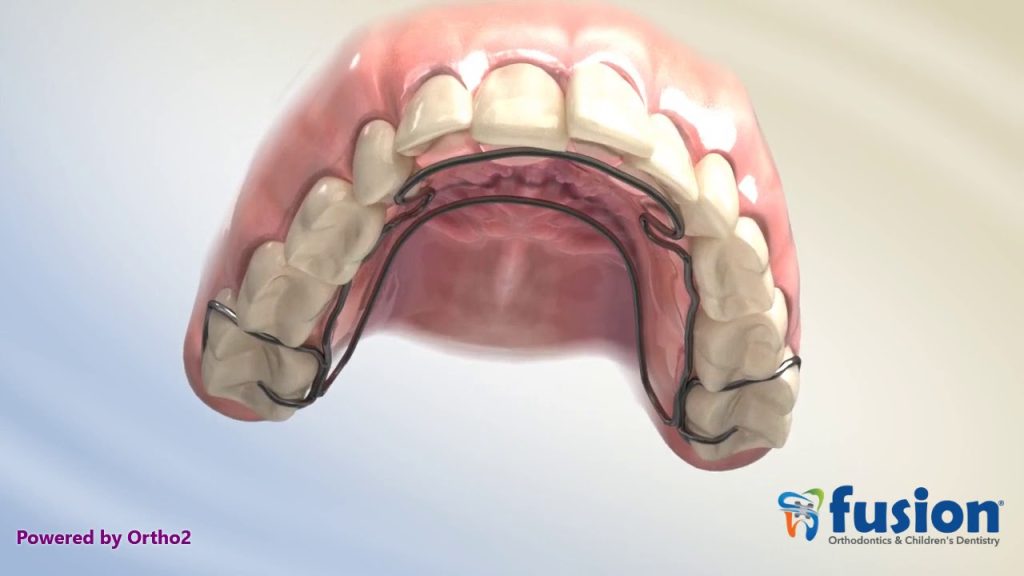 Exploring the Benefits of Crozat Appliance in Orthodontics