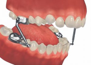 Herbst Orthodontic Appliance: A Guide to Correcting Jaw Misalignment