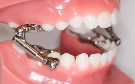 Herbst Orthodontic Appliance: A Guide to Correcting Jaw Misalignment