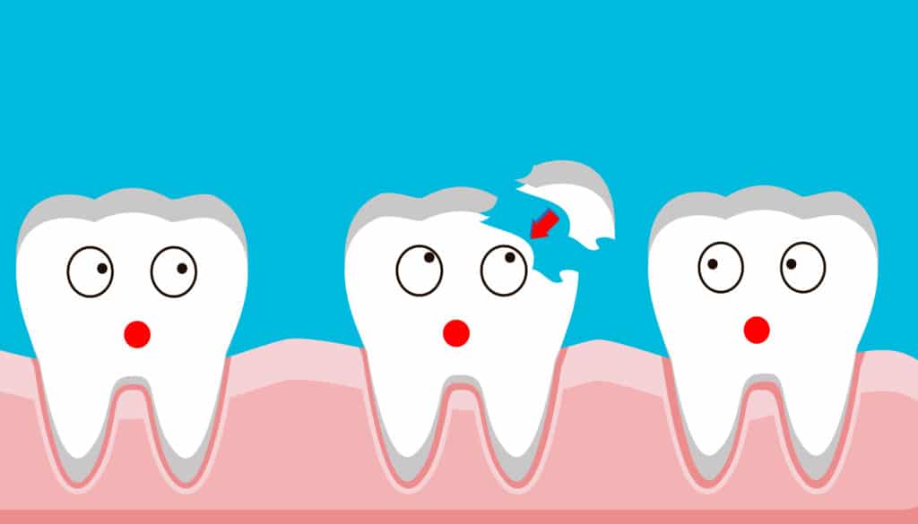 How Much Does it Cost to Fix a Broken Tooth?