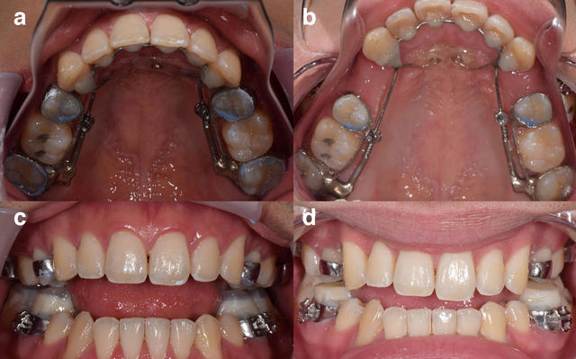 Improving Dental Health with the Agga Appliance