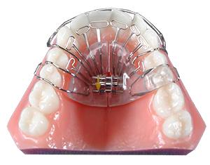 Improving Jaw Alignment with the Homeoblock Appliance