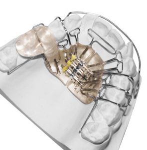 Improving Jaw Alignment with the Homeoblock Appliance