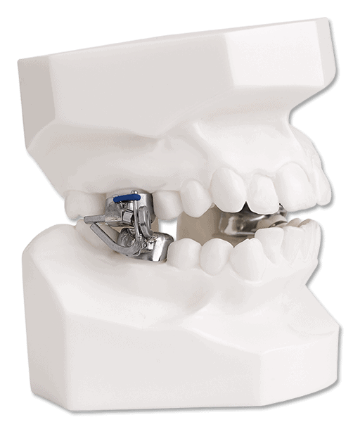 Mara Orthodontic Appliance: An Effective Solution for Orthodontic Treatment