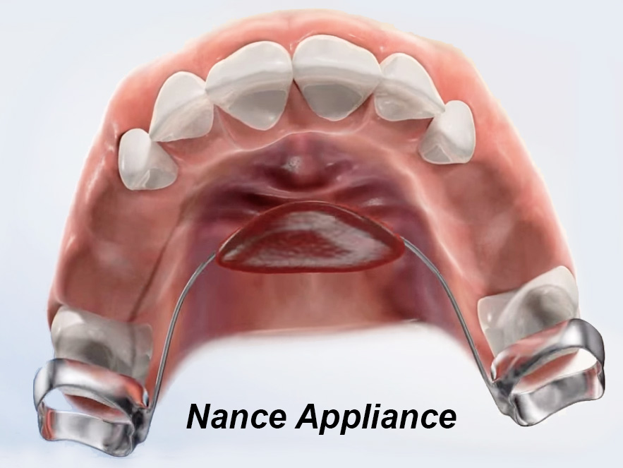 Nance Appliance: A Guide to Orthodontic Treatment