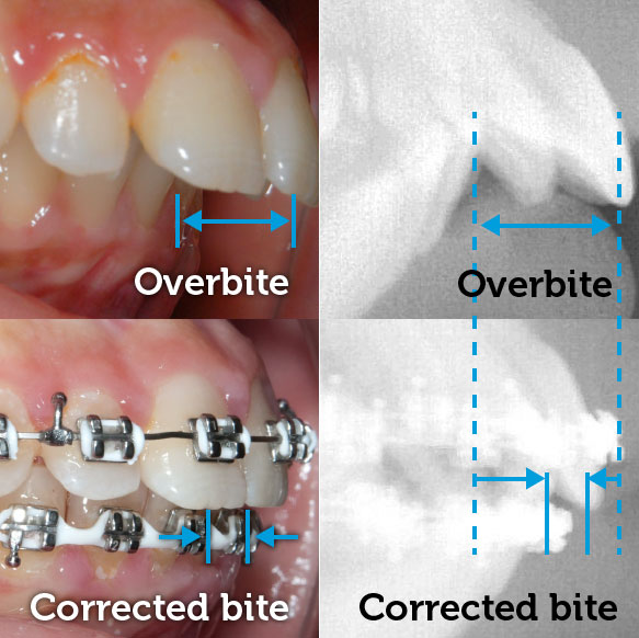 Orthodontic Treatment for Overbite Correction