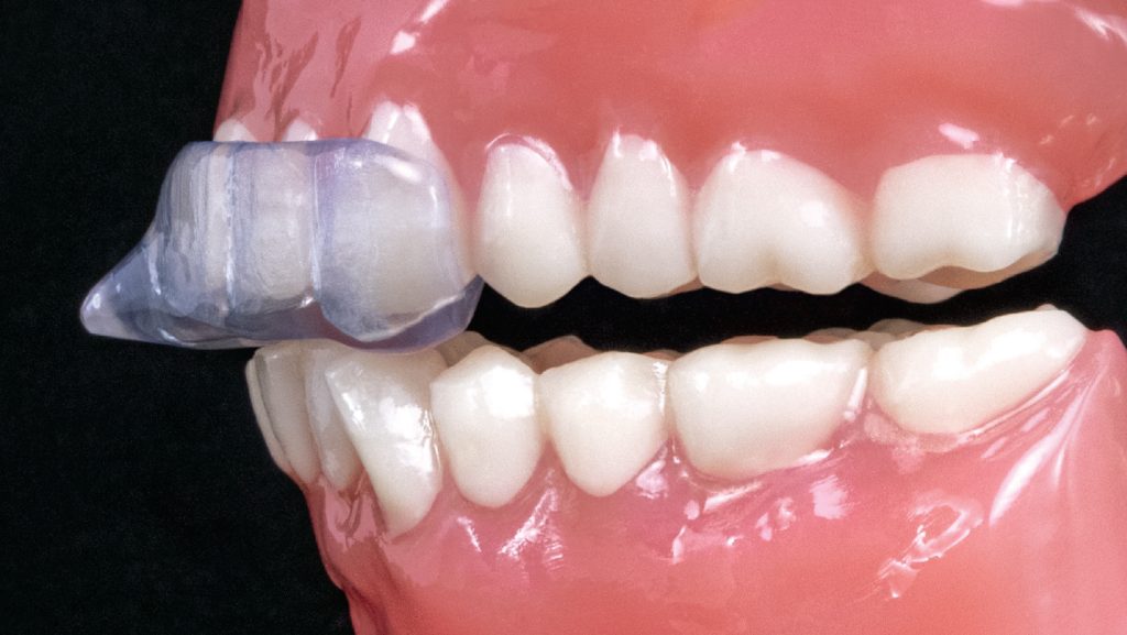 The Benefits of Using an NTI Dental Appliance
