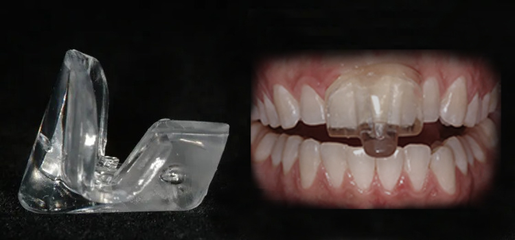The Benefits of Using an NTI Dental Appliance