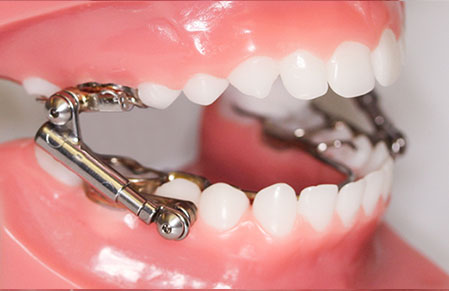 The Benefits of Using Herbst Appliance with Braces