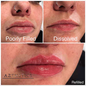 The Cost of Dissolving Lip Filler