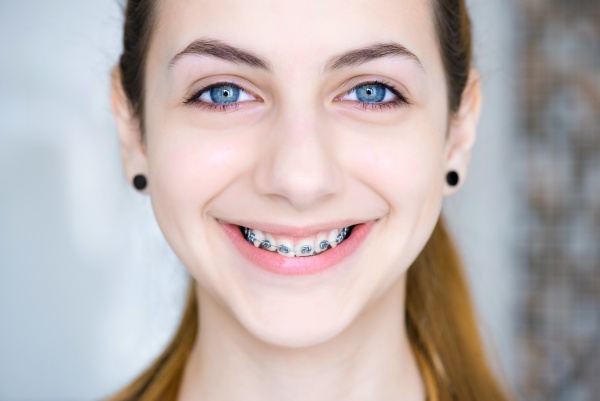 The Importance of Braces in Straightening Teeth