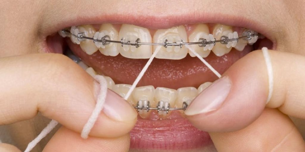 The Importance of Dental Appliances