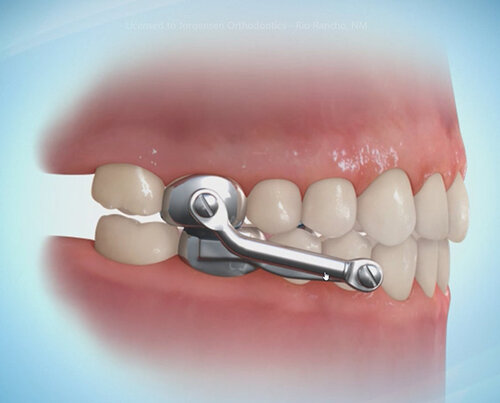 The Importance of Dental Appliances