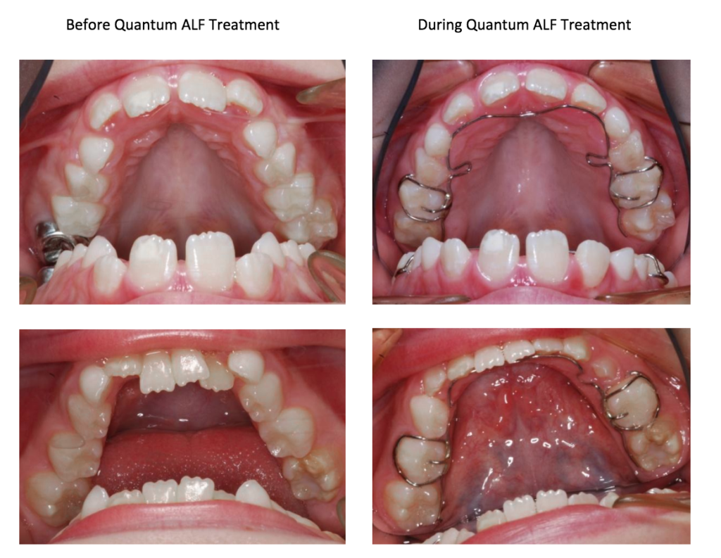 The Importance of Using an ALF Appliance in Orthodontic Treatment