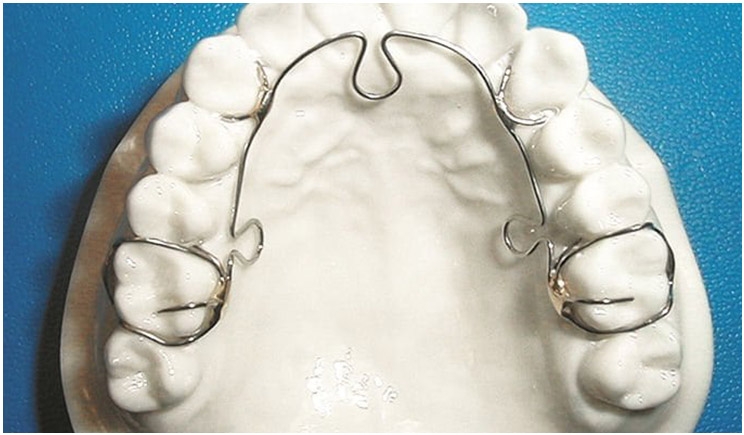 The Importance of Using an ALF Appliance in Orthodontic Treatment