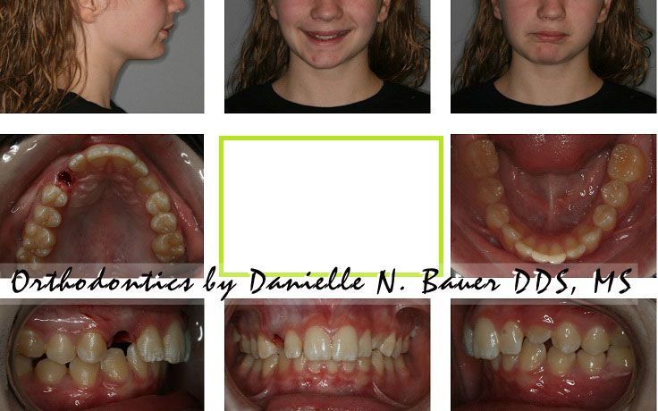 Transforming Smiles: Before and After with the Herbst Appliance