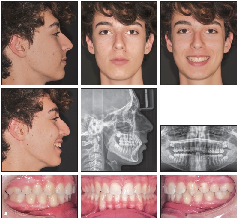 Transforming Smiles: Before and After with the Herbst Appliance