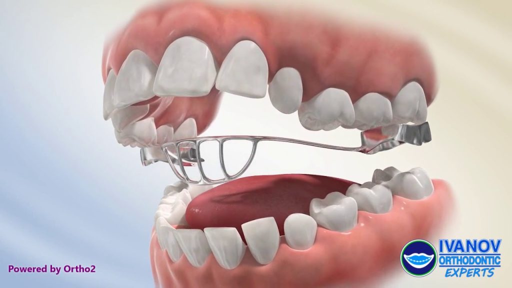 Understanding the Use of Tongue Crib Appliance for Orthodontic Treatment