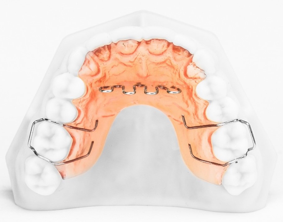 Understanding the Use of Tongue Crib Appliance for Orthodontic Treatment