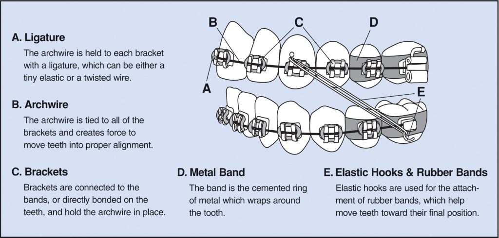 What You Need to Know About Orthodontic Fixed Appliances